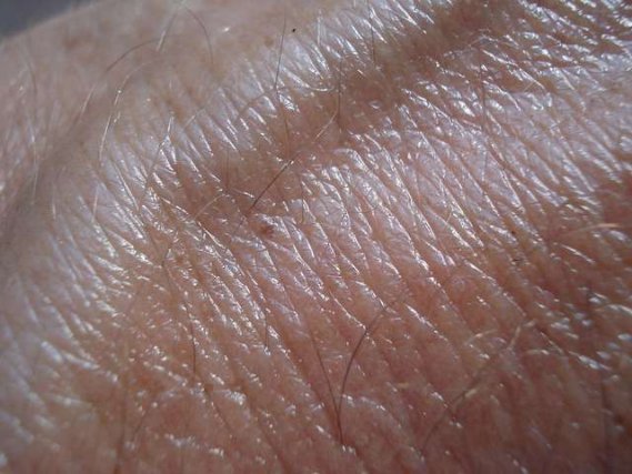 Sunburn: Skin Cancer and Aging of the Skin